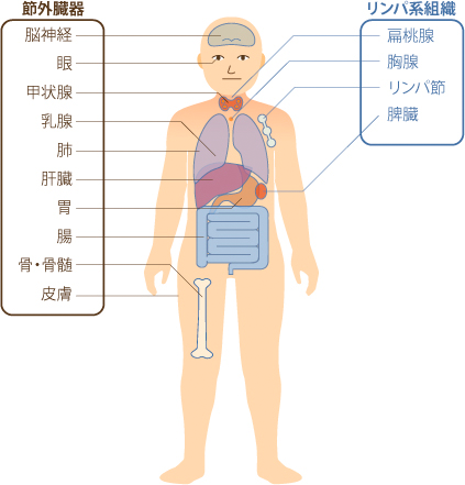 悪性リンパ腫とは