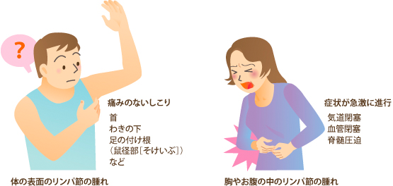 悪性リンパ腫の症状