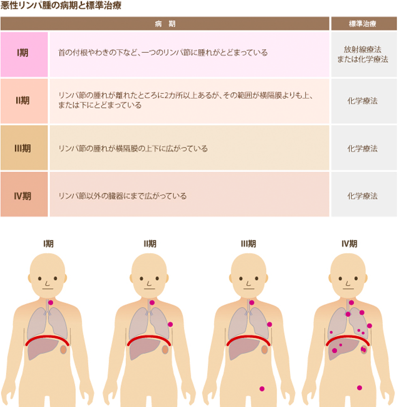 悪性リンパ腫の病期と標準治療