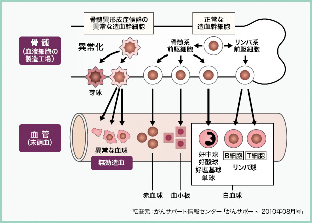 骨髄異形成症候群(MDS)とは