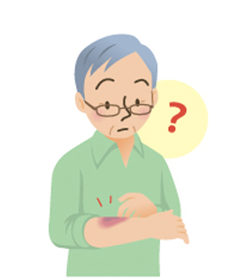 悪性リンパ腫の症状 紫斑（しはん）、点状出血、鼻血